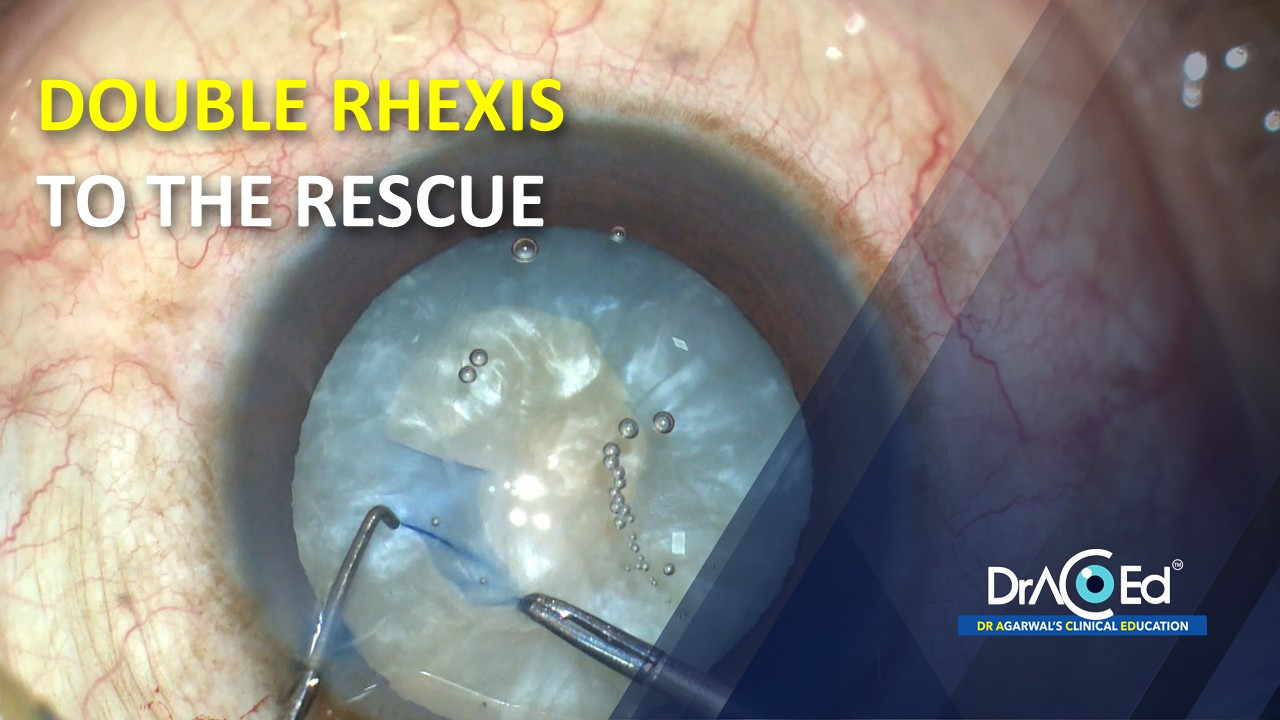 DOUBLE RHEXIS TO THE RESCUE